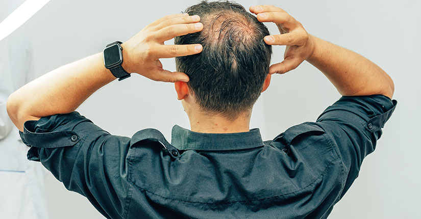 Men’s Health – 5 Effective Guidelines for Male Pattern Baldness