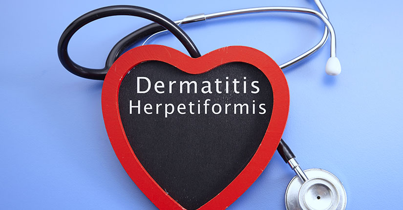 Here’s What You Need to Know About Dermatitis Herpetiformis or Gluten Rash