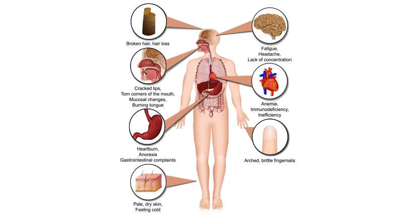 5 Signs To Notice in Your Body About Iron Deficiency