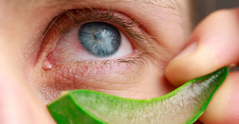 5 Remedies to Cure Dry Eyes