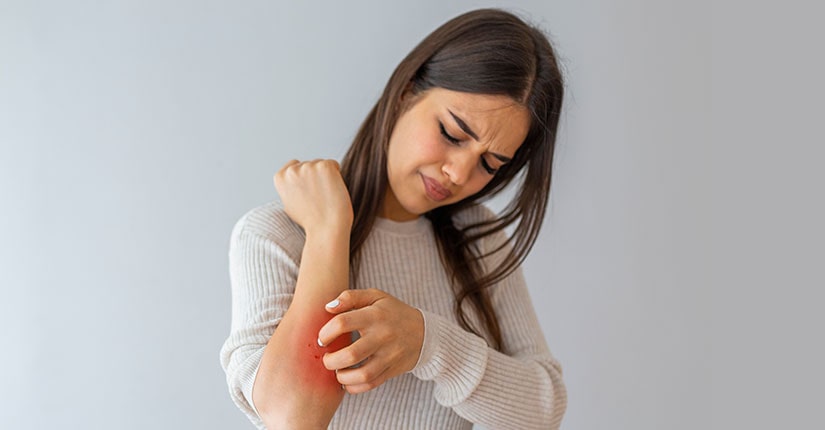 Eczema – 5 food Items to Eat and to Avoid