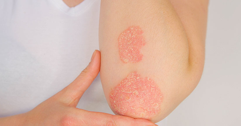 Decoding Psoriasis, an inflammatory Skin disease and its Types