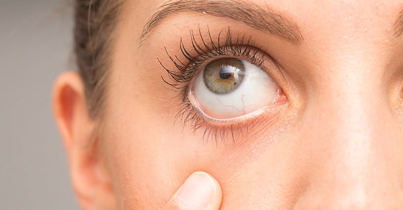 Five Home Remedies that do Wonders to Cure Dry Eyes