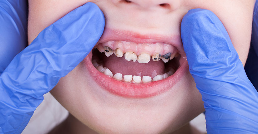 6 Best Practices to Teach Children Right From the Start to Prevent Plaque Buildup & Tooth