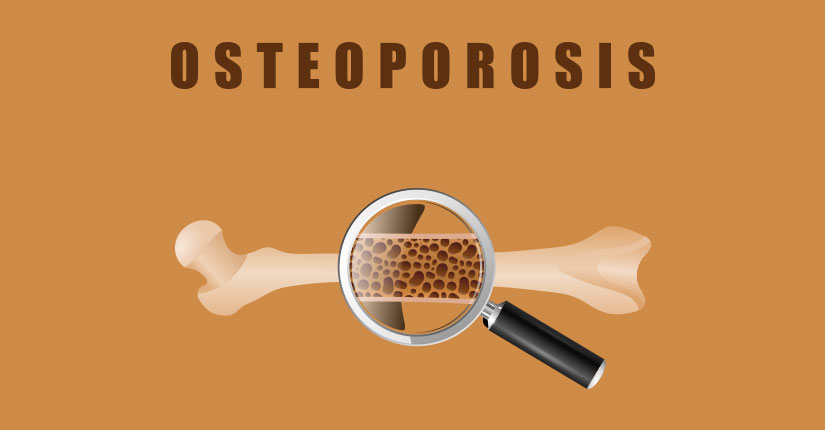 6 Lifestyle Approaches to Help you Manage Osteoporosis