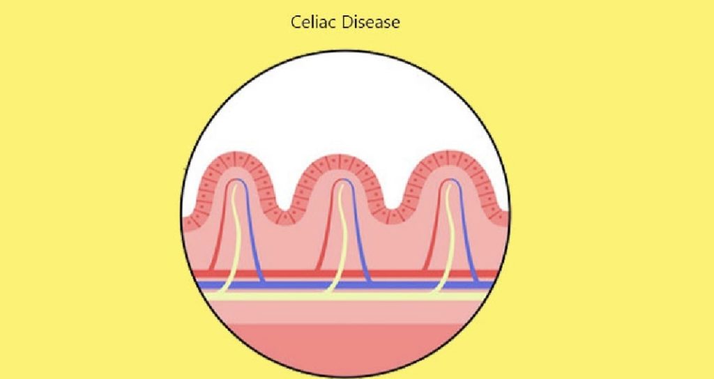 Busting 7 Myths and Facts about Celiac Disease