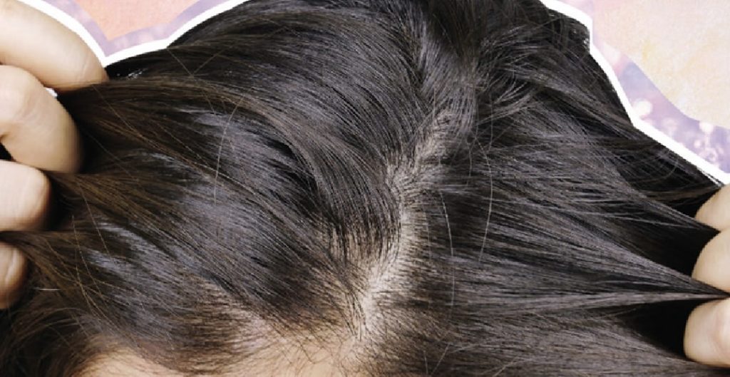 6 Ways to check if your scalp is healthy or not