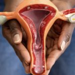5 SIDE EFFECTS OF OVARIAN CANCER TREATMENT: TIPS AND SUPPORT